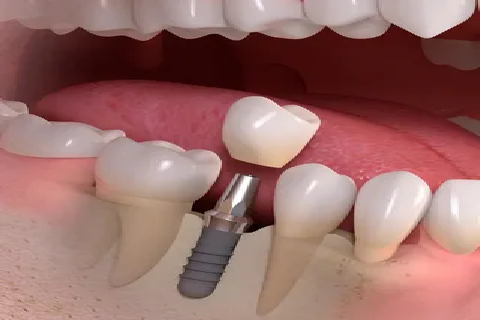 Dental Implants in Lahore