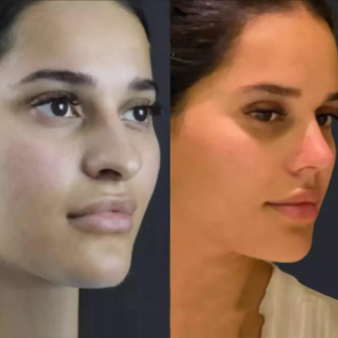 Patient Insights: Selecting a Rhinoplasty Surgeon in Dubai